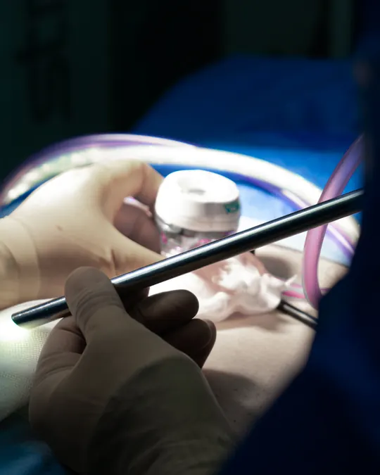 Laparoscopic instruments during a minimally invasive hernia repair in Tijuana